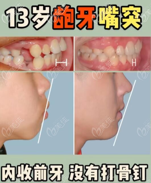 齙牙戴金屬牙套矯正效果對(duì)比圖