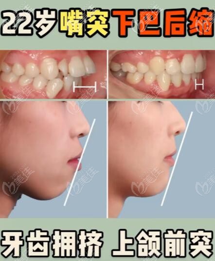 門牙往外突出戴時(shí)代天使隱形牙套矯正效果