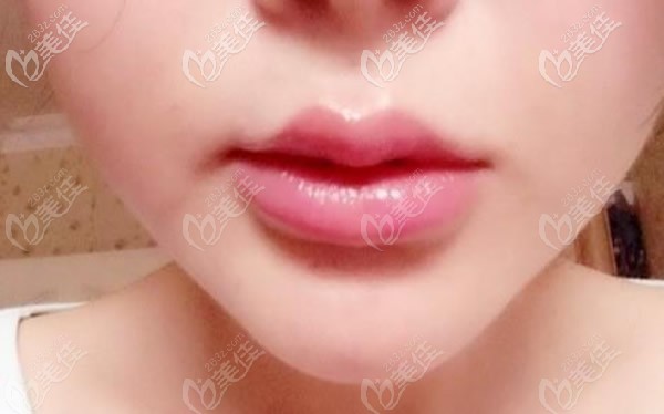 玻尿酸打嘟嘟唇效果 玻尿酸打嘟嘟唇效果