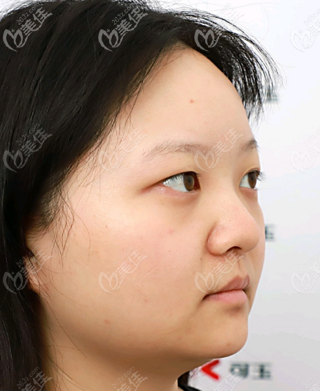 廣州可玉整形醫(yī)院雙眼皮案例術(shù)前照片 廣州可玉整形醫(yī)院雙眼皮案例術(shù)前照片