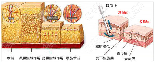 廣州壹加壹黃文誼醫(yī)生吸脂優(yōu)勢 廣州壹加壹黃文誼醫(yī)生吸脂優(yōu)勢