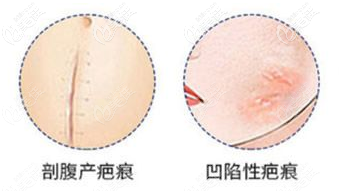 剖腹產(chǎn)疤痕等示意圖