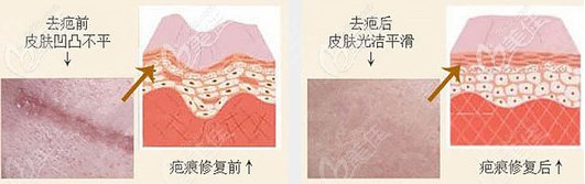 點(diǎn)陣激光去疤痕過(guò)程示意圖