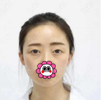 做眼綜合手術(shù)前 做眼綜合手術(shù)前