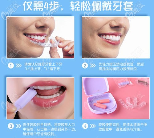 隱形牙套的佩戴方式
