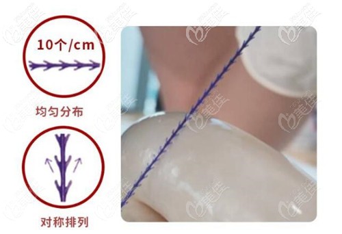 藍(lán)鉆魚(yú)骨線的優(yōu)勢(shì) 藍(lán)鉆魚(yú)骨線的優(yōu)勢(shì)