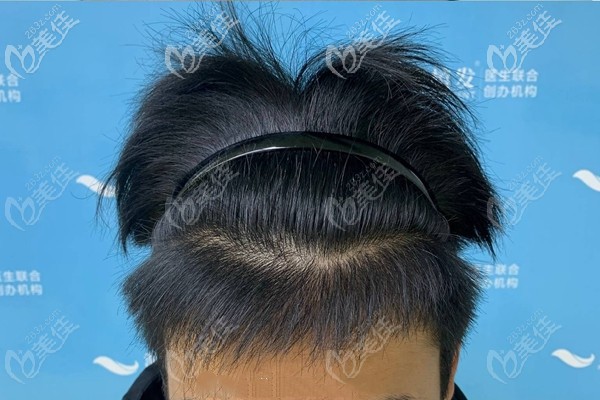 日記:種植30平方厘米發(fā)際線的價格和發(fā)際線種植4個月效果圖