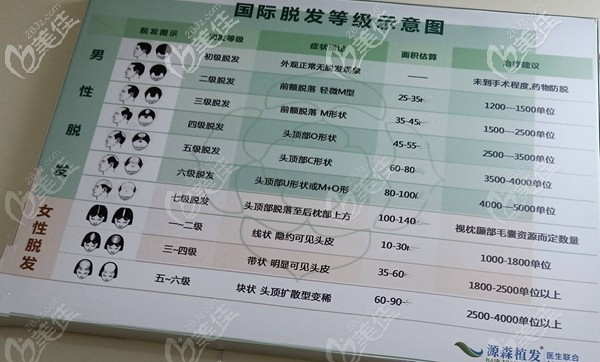 男士脫發(fā)面積等級圖 男士脫發(fā)面積等級圖