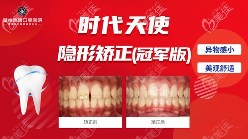 湖州鼎植做牙齒矯正價格貴嗎