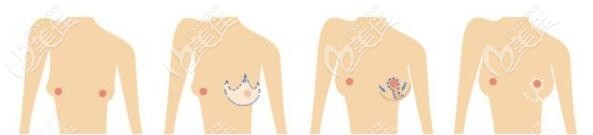 雙環(huán)法乳房懸吊術(shù)操作過程圖解