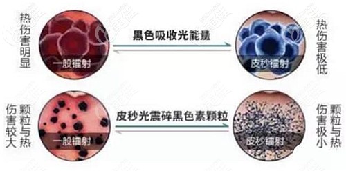 極光超皮秒去斑的能量