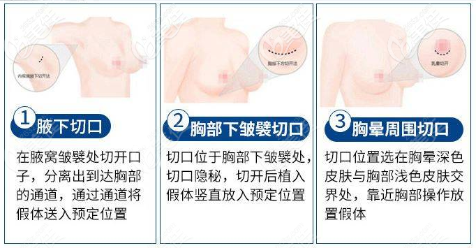 湛江澳泰整形醫(yī)院隆胸優(yōu)勢