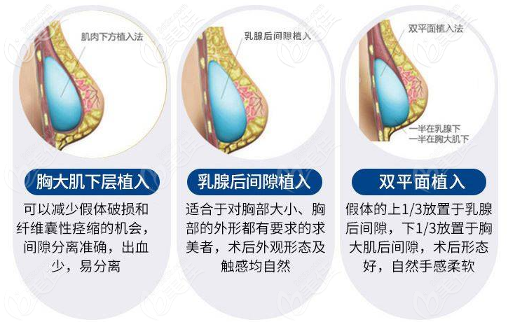 湛江澳泰整形醫(yī)院隆胸植入層次<span style=