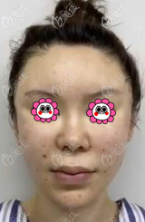 在北京童仁做完SAMS筋膜面部提升手術(shù)到現(xiàn)在,真沒發(fā)現(xiàn)有啥危害