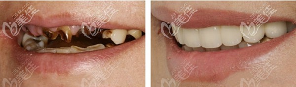 福州貝臣口腔登騰Allon4半口種植牙效果真不錯(cuò)，果然專業(yè)醫(yī)生和儀器少不了