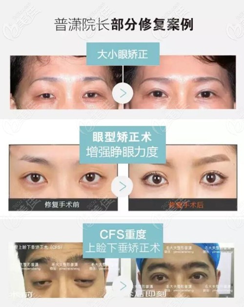 普瀟雙眼皮修復(fù)案例