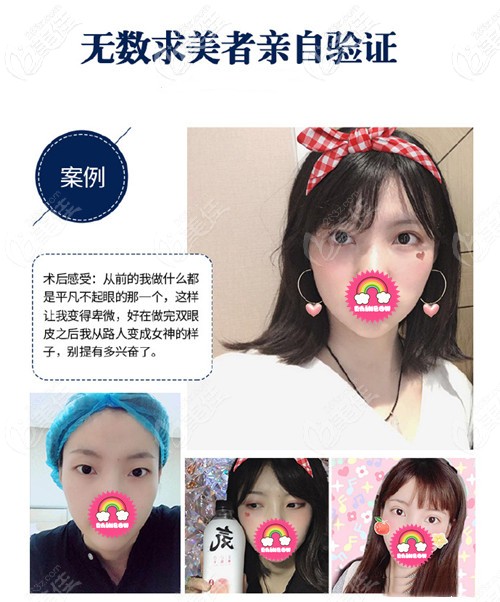 宋峻嶺雙眼皮對比案例