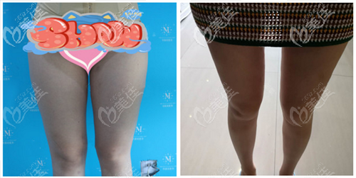 青島華顏美張慶吸脂案例