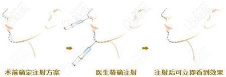 伊婉玻尿酸v型適合打下巴和鼻子