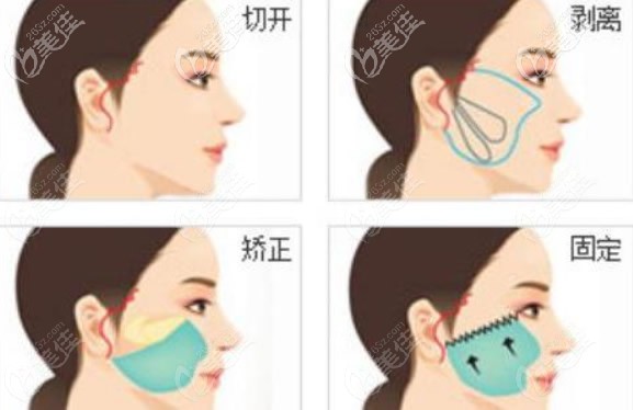 面部大拉皮手術(shù)操作流程