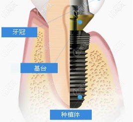 喜迎元旦，邢臺(tái)宏皓口腔特推出百康特種植牙活動(dòng)，只要3499元起