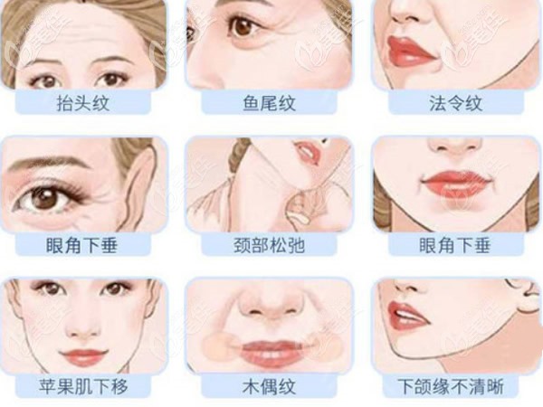 拉皮手術(shù)能改善哪些面部問題