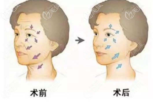 拉皮手術(shù)對(duì)比照片