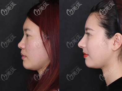 膨體隆鼻+肋軟骨鼻尖成形效果圖