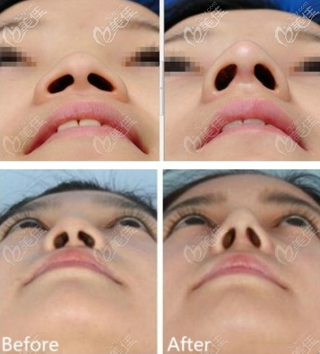 塌鼻做鼻綜合術后效果圖