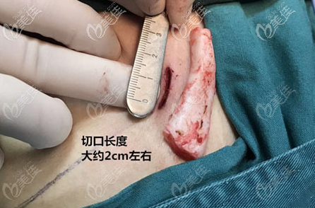 取肋軟骨的切口大小