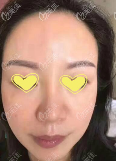 臉下垂用人工韌帶提升會傷面部神經(jīng)嗎?過來人說說自己的親身經(jīng)歷