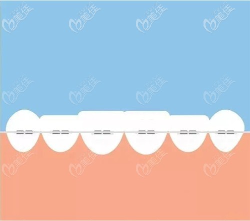 舌側(cè)保持器會反彈嗎