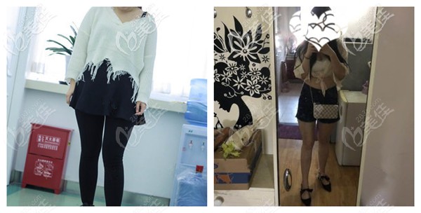 隔空爆脂儀瘦腿對比