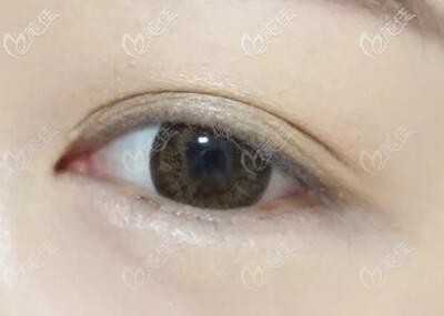 割雙眼皮眼尾處褶皺短點好看還是長點好看呢