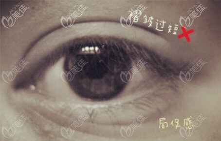 雙眼皮眼尾處褶皺過段的缺點