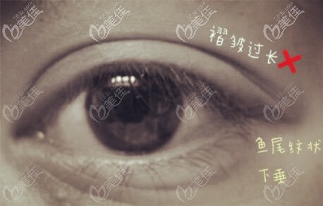 雙眼皮眼尾處褶皺短長的缺點