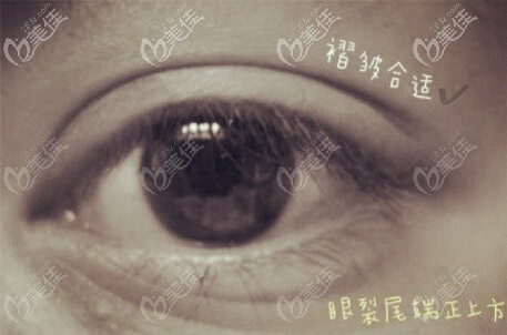 雙眼皮眼尾處褶皺適中