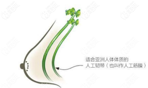 人工韌帶乳房提升術(shù)利弊