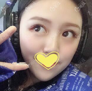 打伊婉玻尿酸豐下巴術(shù)后一個月效果圖