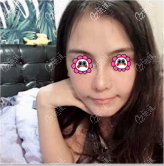 體驗(yàn)北京童仁高光微創(chuàng)眉弓術(shù),發(fā)現(xiàn)用仿生韌帶填充眉弓效果也不錯(cuò)