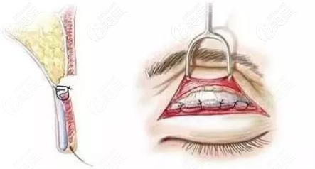 切開雙眼皮形態(tài)