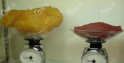 btl射頻溶脂多久做一次效果才會好呢