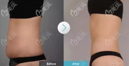 BTL超級射頻溶脂真人前后對比照