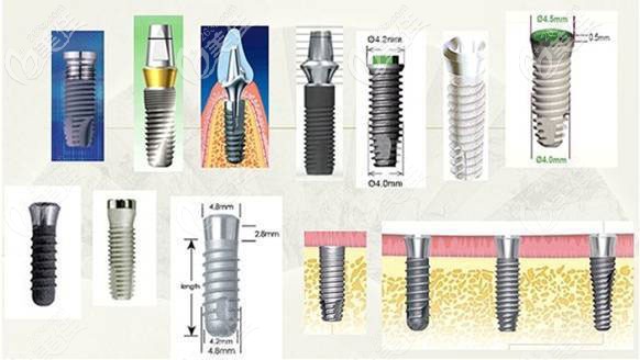 不同品牌的種植系統(tǒng)
