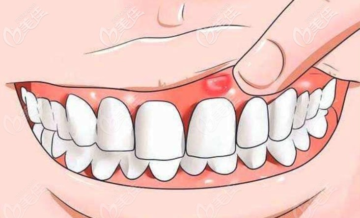 牙齦上起了膿包怎么辦