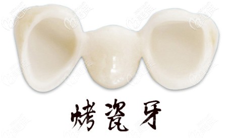 未成年人可以考慮烤瓷牙來修復