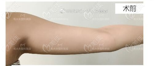 手臂吸脂前 手臂吸脂前