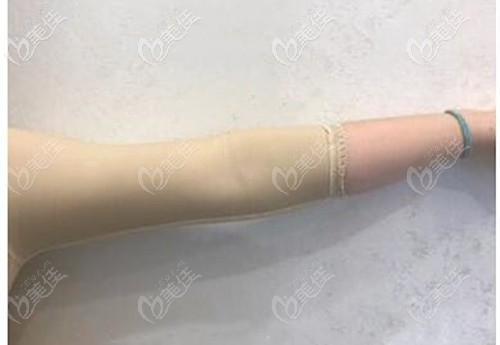 手臂吸脂后穿塑身衣 手臂吸脂后穿塑身衣
