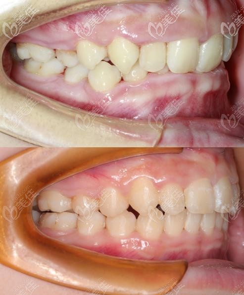 矯正的前后對比