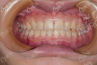 成都錦江區(qū)極光口腔做深覆合矯正案例圖到,速來查收效果！